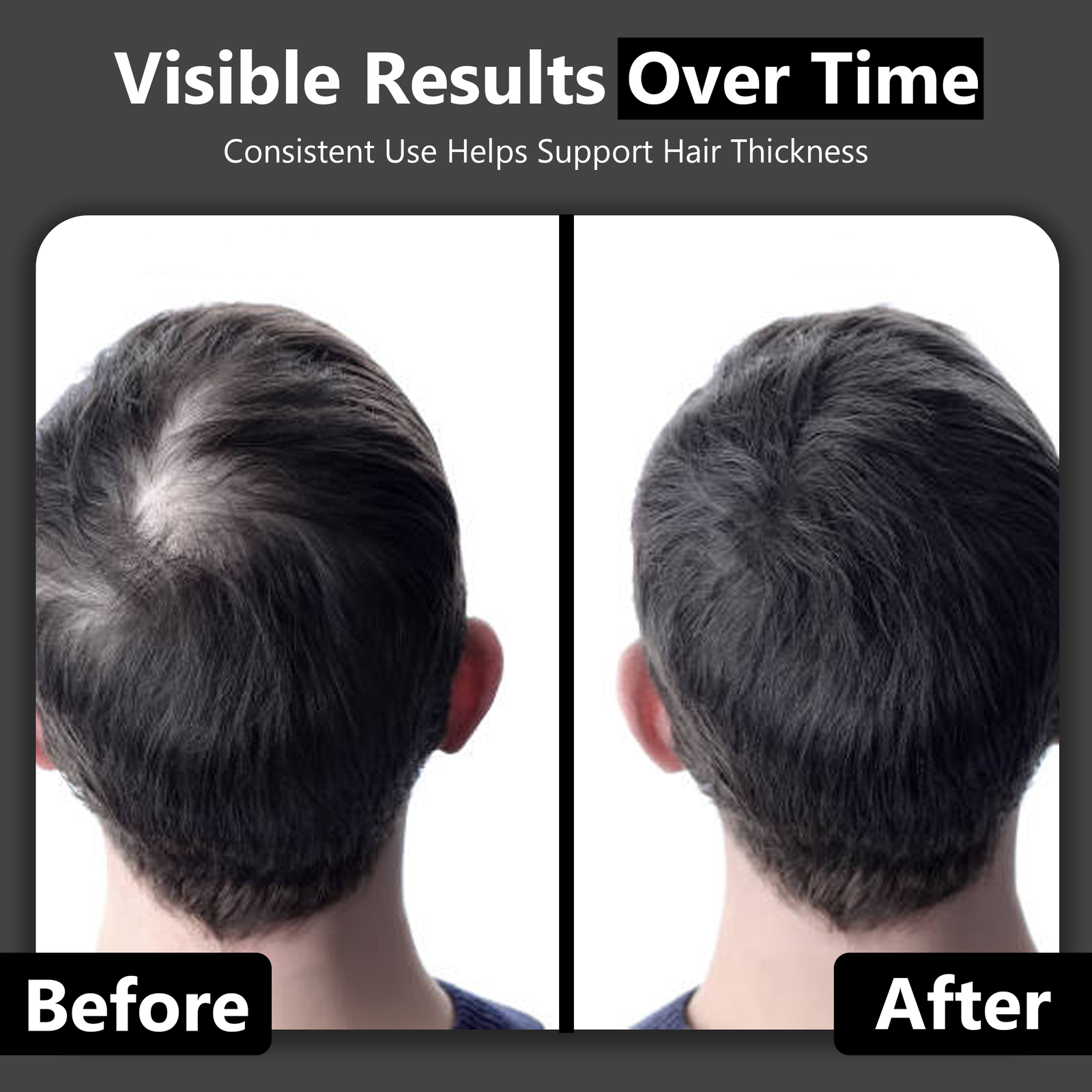 2nd helmat 82 Diode Laser Hair Growth Cap | 650nm LLLT Hair Restoration